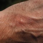 écorchure que faire