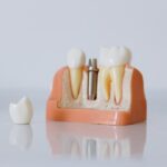 Tout savoir sur l’implant dentaire