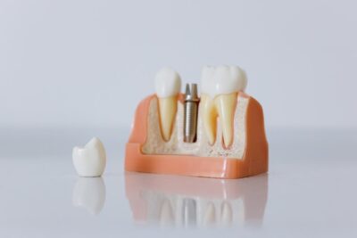 Tout savoir sur l’implant dentaire
